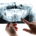 大人乳歯になる原因は先天性！もし抜けたらどうするの？